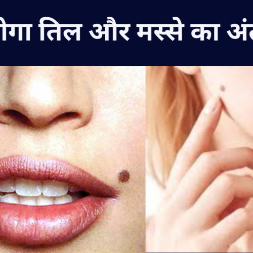 तिल और मस्से